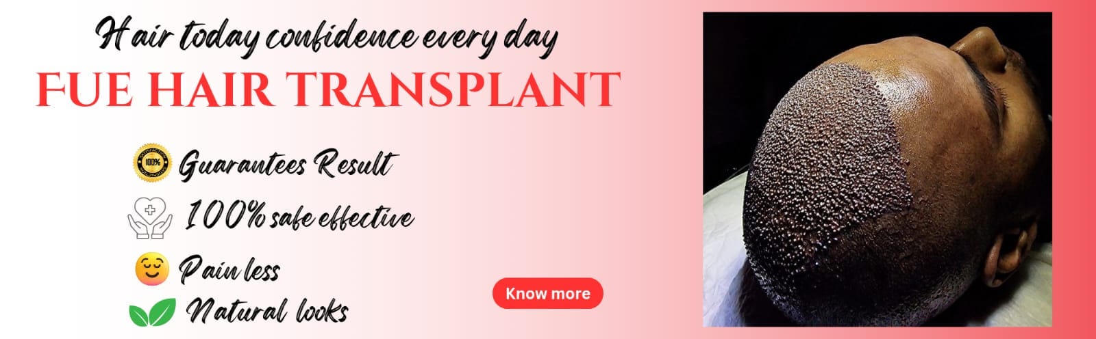 FUE Hair Transplant – Guaranteed Results, Safe & Natural Outcome Close-up photo showing the result of an FUE hair transplant with newly implanted grafts on the scalp