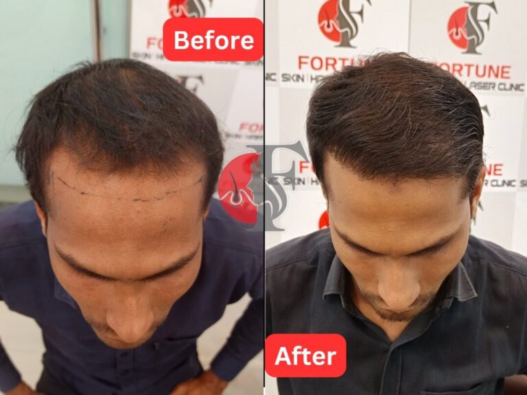 "Hair restoration results of a male patient from Malegaon at Fortune Skin/Hair/Laser Clinic. The image showcases a significant transformation, with the patient progressing from visible hair loss to a full and natural hairline in a professional clinic setting."