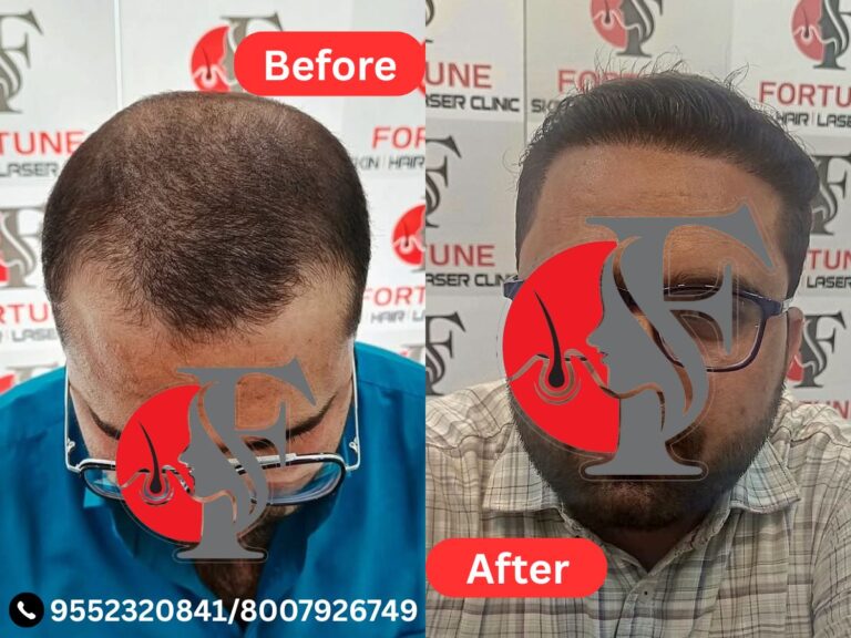 HAIR TRANSPLANT