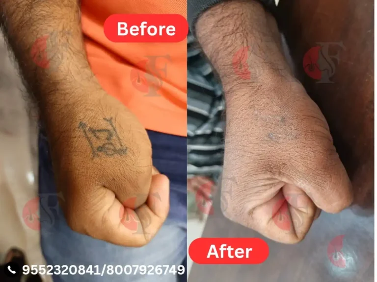 LASER TATOO REMOVAL