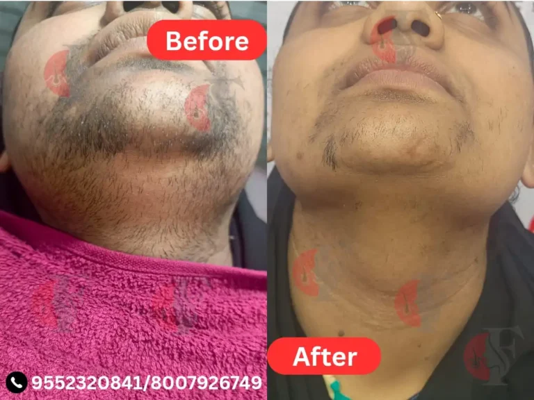 LASER HAIR REMOVAL
