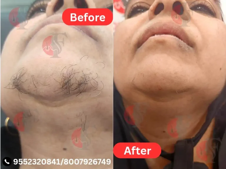 LASER HAIR REMOVAL