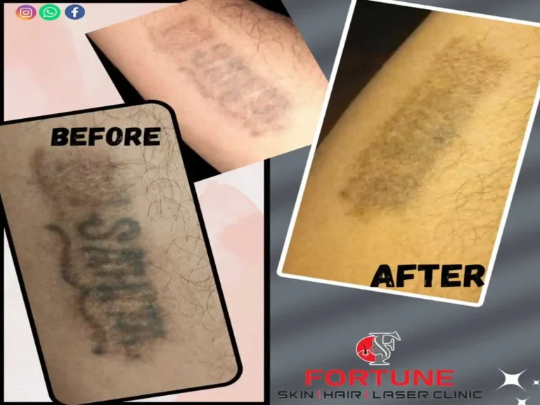 LASER TATOO REMOVAL
