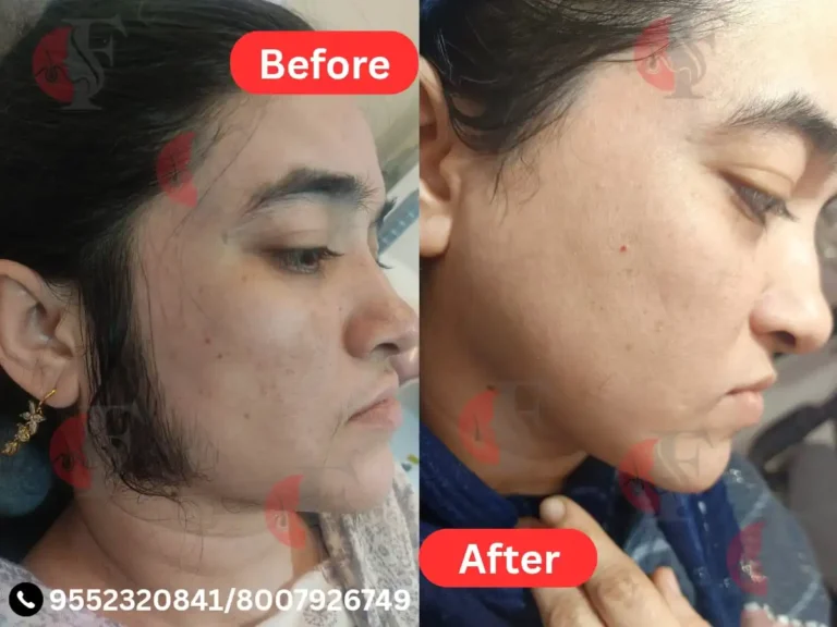 LASER HAIR REMOVAL