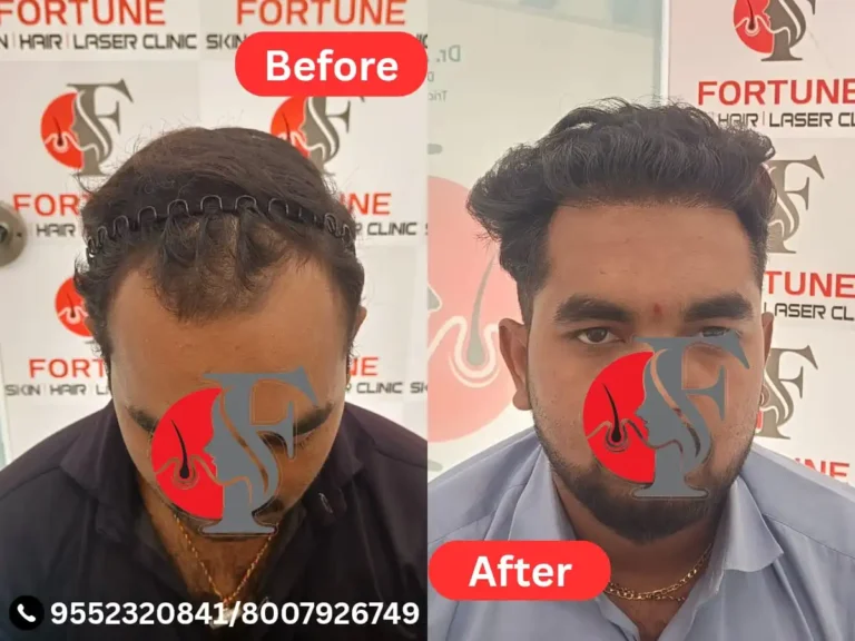 "26-year-old male from Dhule with frontal baldness restored using 2000 grafts at Fortune Clinic Malegaon — well-defined dense hairline and natural growth result after hair transplant"