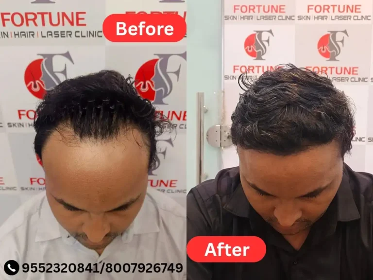 Before and after image of a 37-year-old male from Malegaon who received 2400 grafts at Fortune Clinic. He got a natural, dense hairline along with coverage from the front to the crown area. The transformation after 8 months shows excellent hair growth and a completely natural look. Chose Fortune Clinic for its results and affordable hair transplant cost in Malegaon.