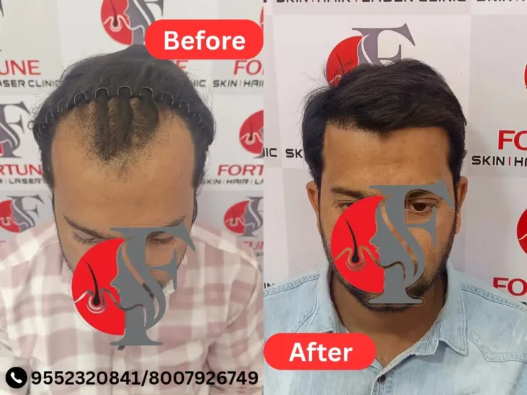 "28-year-old male from Dhule restored a natural, dense hairline with 2500 grafts at Fortune Clinic Malegaon — enhanced frontal density with slight mid-scalp coverage for a balanced, youthful appearance"
