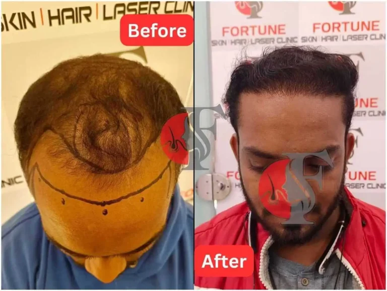 Before and after image of a 26-year-old male from Malegaon who received 3000 grafts at Fortune Clinic. After visiting several clinics in Malegaon, he chose us for our natural hairline results and budget-friendly hair transplant cost. Densely corrected hairline shown at 6 months post-surgery. PRP therapy also done on the remaining scalp area, showing excellent improvement.