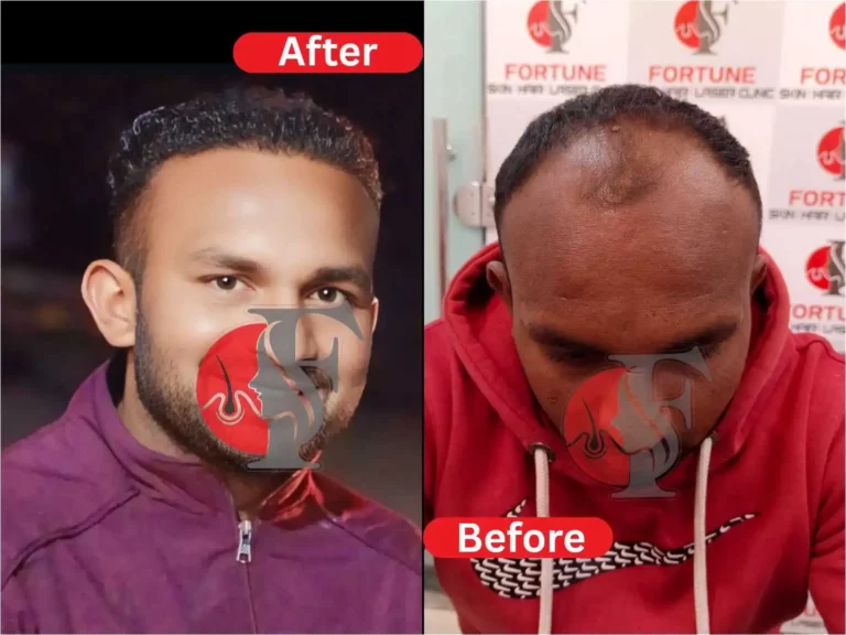 "Before and after 5 months result of 3500 grafts hair transplant in 26-year-old male from Dhule at Fortune Clinic Malegaon — natural dense hairline and mid-scalp restored with excellent outcome"