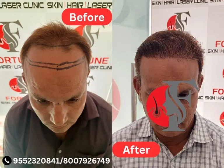 Before and after photo of a 45-year-old Malegaon resident who received 3500 grafts at Fortune Clinic. Hairline was artistically rebuilt with added coverage to the mid-scalp, restoring a natural and age-appropriate look. Just 5 months after the procedure, visible density and balanced hair growth made a remarkable difference.