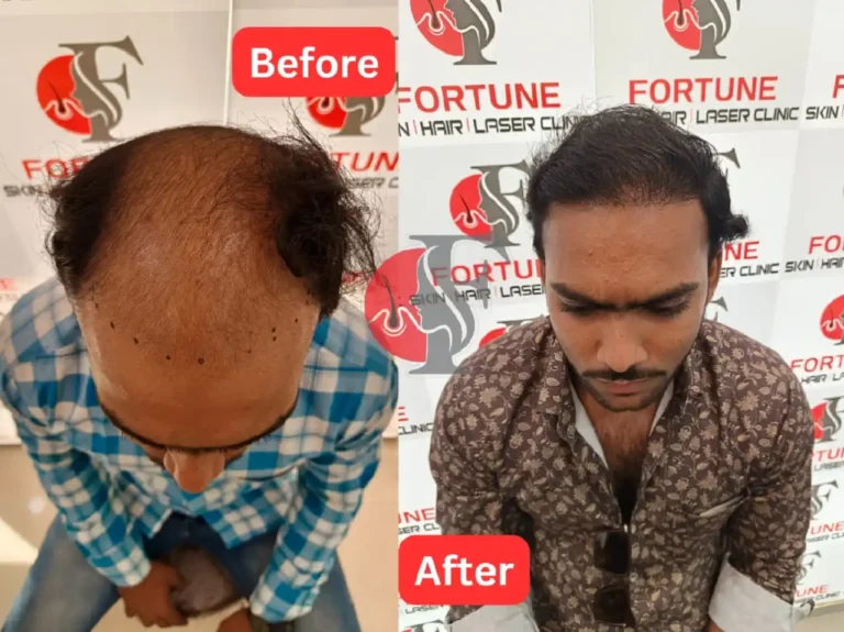Before and after image of a 30-year-old male from Malegaon who underwent 5000 graft hair transplant at Fortune Clinic. After seeing our successful results and affordable pricing, he chose us. Full hairline to crown restoration was done, giving him a dense, natural look across the entire scalp. Stunning visible change after just 6 months.