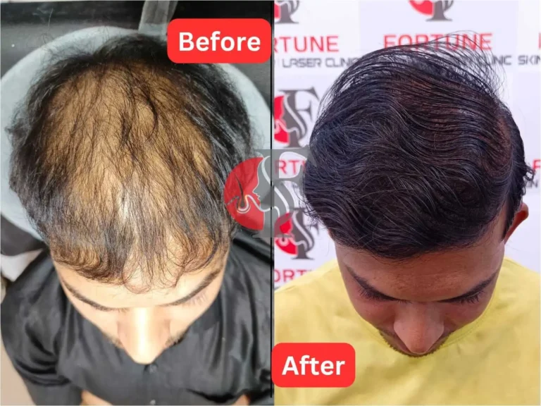 Before and after result of a 25-year-old male from Malegaon treated at Fortune Clinic with 5000 grafts for diffuse pattern baldness; full reconstruction of hairline, mid-scalp, and crown with dense natural coverage.