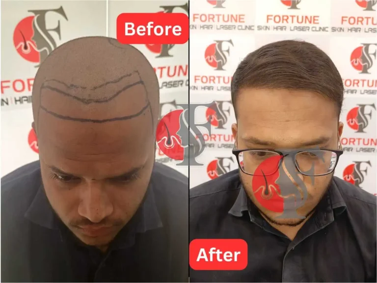 "25-year-old male from Dhule achieved a sharp and dense hairline with 2800 grafts at Fortune Clinic Malegaon — visible improvement in frontal zone with refined hairline design"