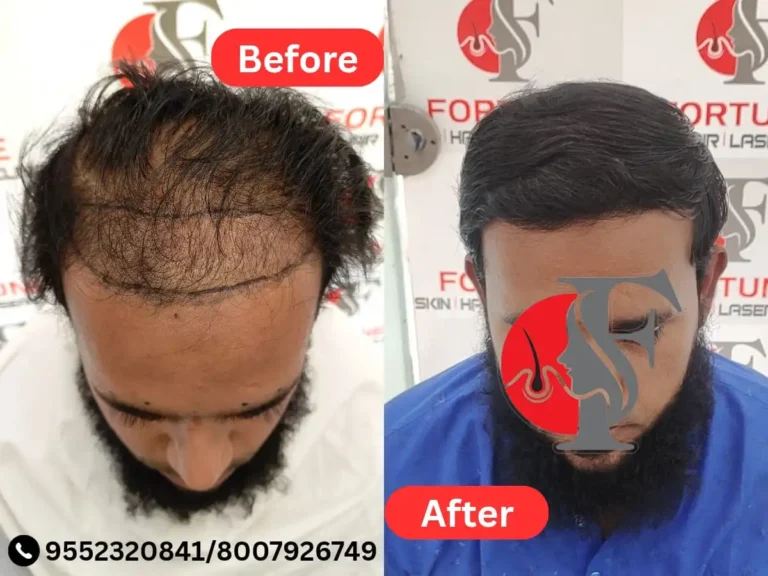 Result of a 26-year-old male from Malegaon who chose Fortune Clinic for a 3500 graft hair transplant. The procedure enhanced his frontal hairline and filled part of the mid-scalp, restoring youthful volume. Noticeable transformation achieved within just 5 months, with clean, defined hairline aesthetics.